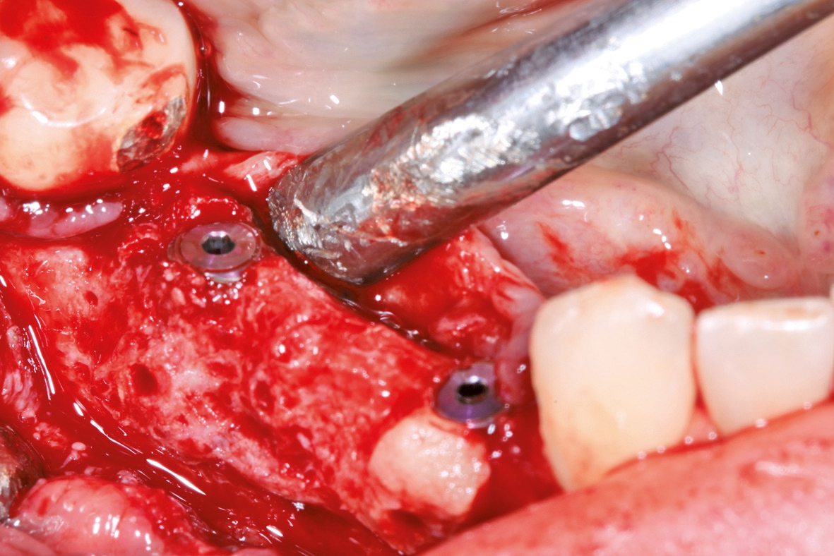 Abb. 12: Implantation im allogenen Augmentationsgebiet.