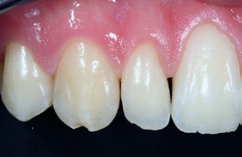 Abb. 12: Ausgangssituation: inzisales Chipping unklarer Genese an Zahn 13.
