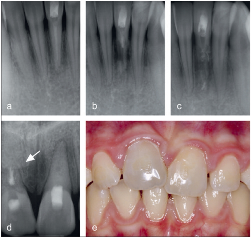 Abb. 11a–c: Röntgenaufnahmen des Zahnes 41 nach einem Avulsionstrauma zeigen eine Ersatzresorption (6, 12 und 24 Monate). d u. e: Der ankylosierte Zahn 11 (Pfeil) zeigt eine Verfärbung und befindet sich in Infraposition.