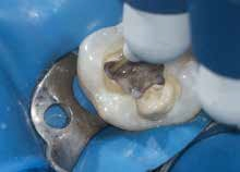 Abb. 12: Mithilfe eines fließfähigen Bulkfill-Komposits (SDR, Dentsply Sirona) …