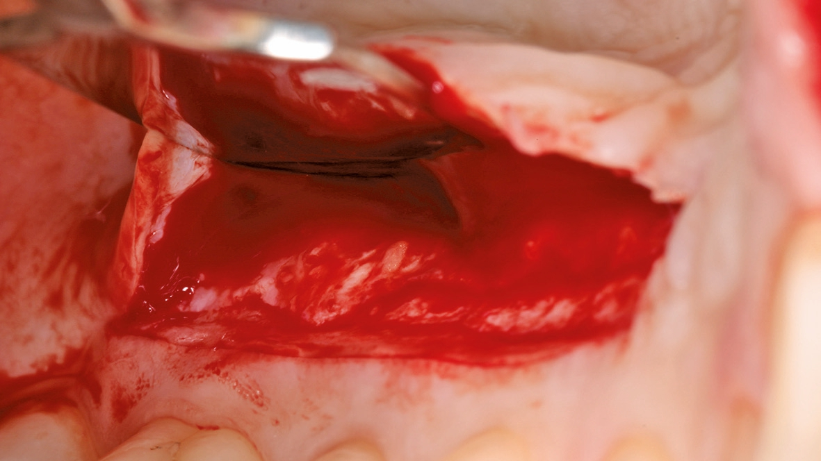 Abb. 10c: Bindegewebetransplantat (BGT) – Entnahme aus dem Gaumen.