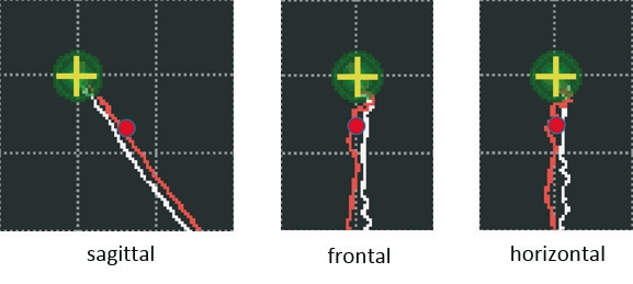 Abb. 12: Die konstruierte therapeutische Position (TP) des rechten Kondylus. Der rote Punkt markiert die gewählte TP auf der Protrusionsbahn.
