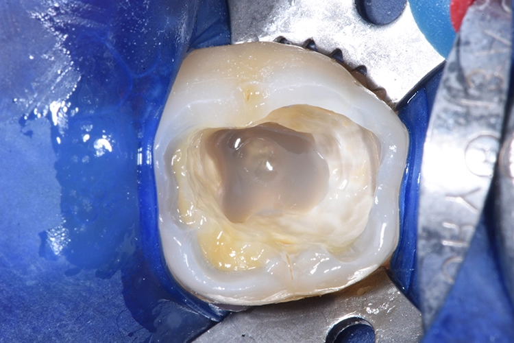 Abb. 13: 1. Schicht Tetric PowerFlow. Durch den in der endodontischen Kavität unvermeidbaren größeren Abstand zum Lichtleiter ist es bei der Polymerisation ratsam, die empfohlene Belichtungszeit zu verdoppeln.