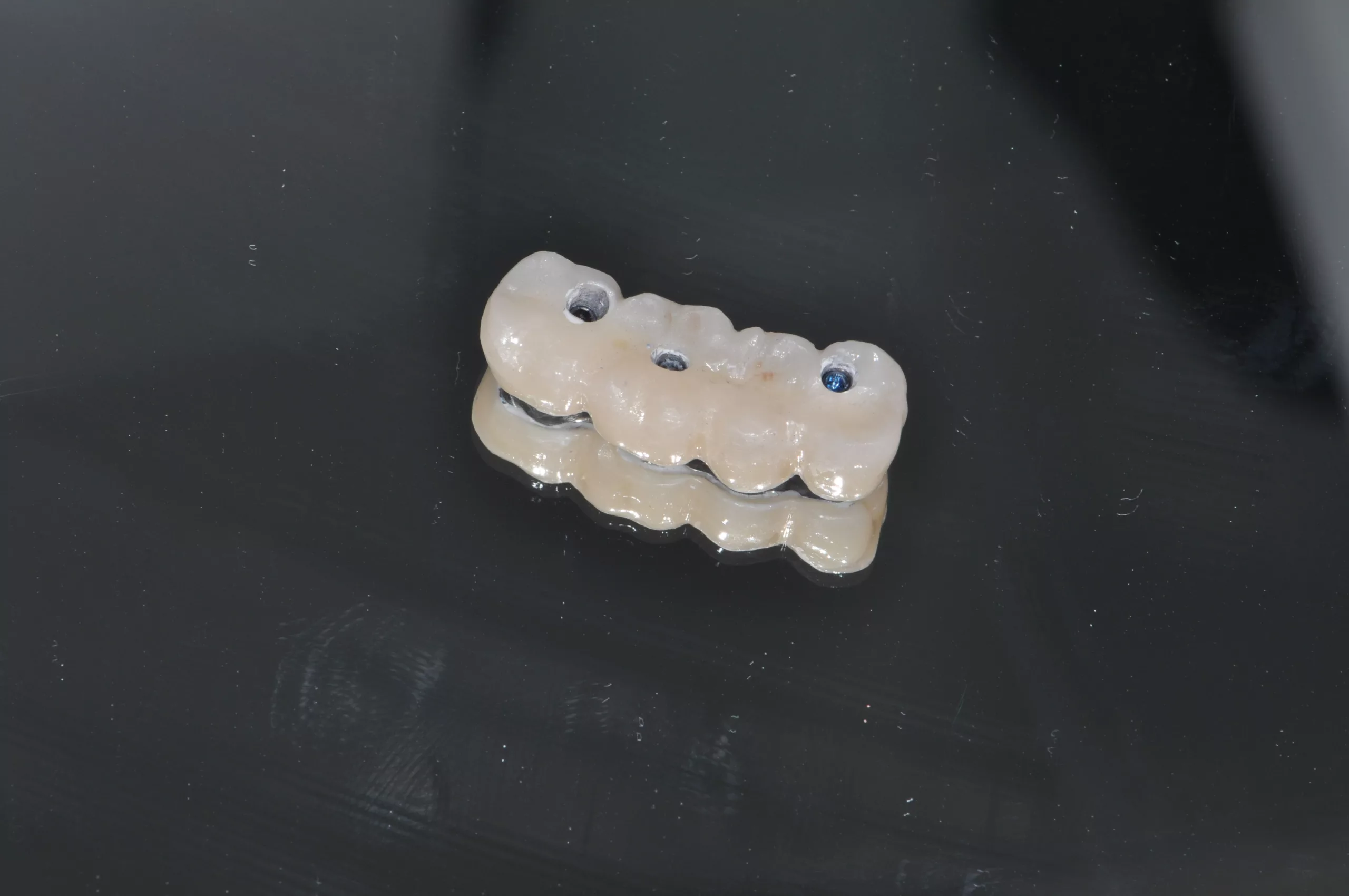 Abb. 13: Endgültig keramisch verblendete Brücke.