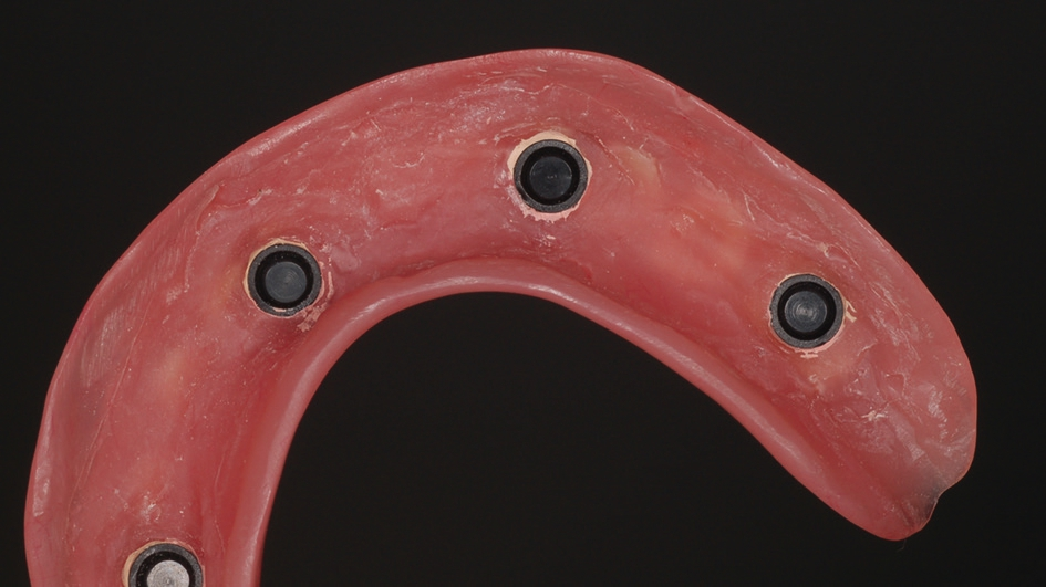 Abb. 14: In die Prothesenbasis eingearbeitete Easy-Con Retentionskappen mit Fertigungseinsatz aus Polyamid.