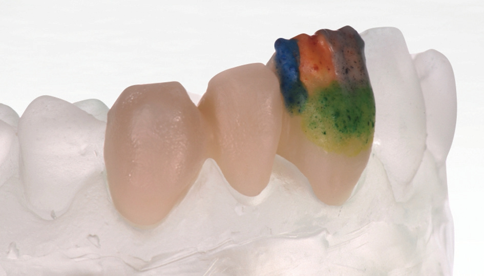 Abb. 11b: Das Schmelzband wird aus EE 1, einer hellen Enamel-Effekt-Masse, sowie Dentinoenamel Junction in EE 2 und EE 4 gestaltet, die approximalen Transpa-Wülste entstehen aus EE 5 oder EO 5.
