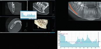 Abb. 16: MPR, PAN Detail, Histogramm, unizystisches Ameloblastom, 1 Jahr postoperativ.