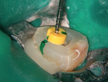 Abb. 14: Neue optimierte Trepanationsöffnung und Beginn der Wurzelkanalbehandlung, reproduzierbare Längenmessung ist jetzt möglich.