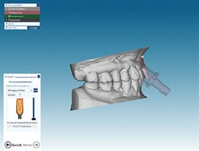 Abb. 17: Erkennen der Implantatposition in der Software.