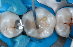 Abb. 13: Volumenersatz des Dentins mit einer 4 mm dicken Schicht mit dem fließfähigen Bulk-Fill-Ormocer Admira Fusion x-base.