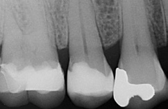 Abb. 13: Ausschnitt aus der endodontologischen Diagnostik-Aufnahme: Es zeigt sich eine sehr gute Röntgenopazität sowie ein sehr gutes approximales Adaptationsverhalten.