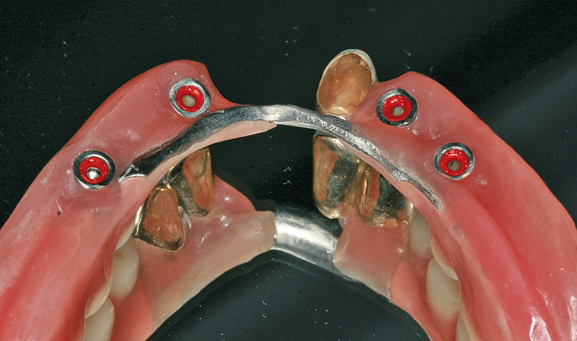 Abb. 13: Die O-Ring-Matrizen zum Verankern des Zahnersatzes sind in den basalen Bereich des vorhandenen Zahnersatzes eingebracht.