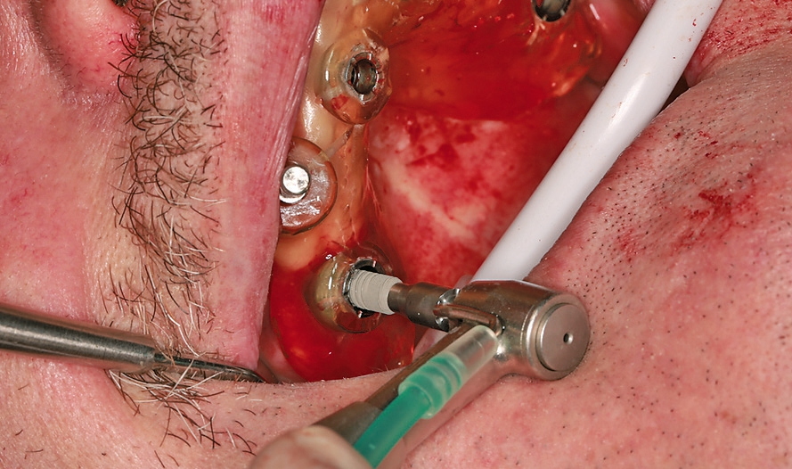 Abb. 13: Implantation an regio 16.