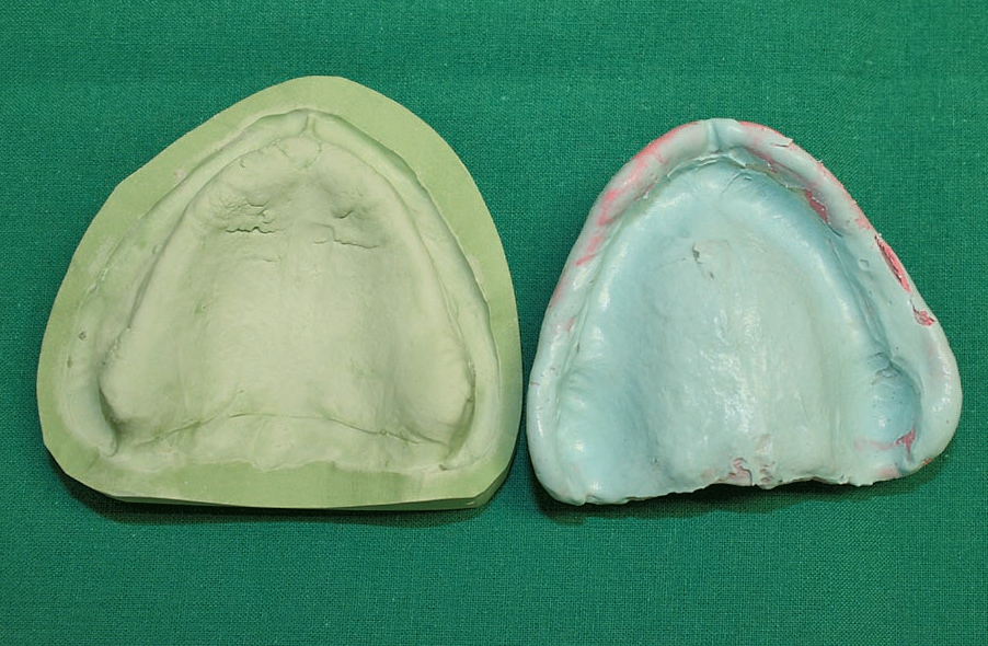 Abb. 8: ... und das Gleiche für den Oberkiefer.