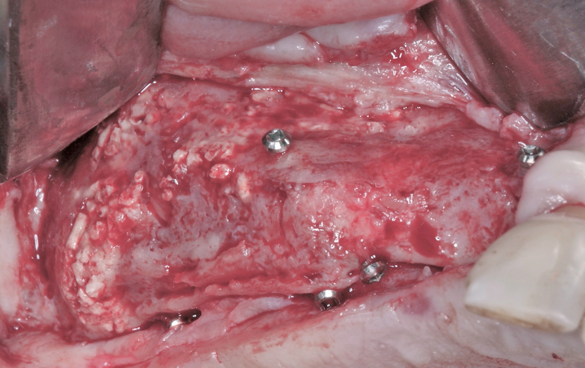 Abb. 13: Der gut revaskularisierte Knochen. Keine erkennbare Resorption im Bereich der Fixationsschrauben.