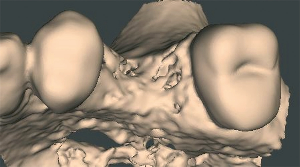 Abb. 13: Virtuelle Darstellung des dreidimensionalen Defektes.