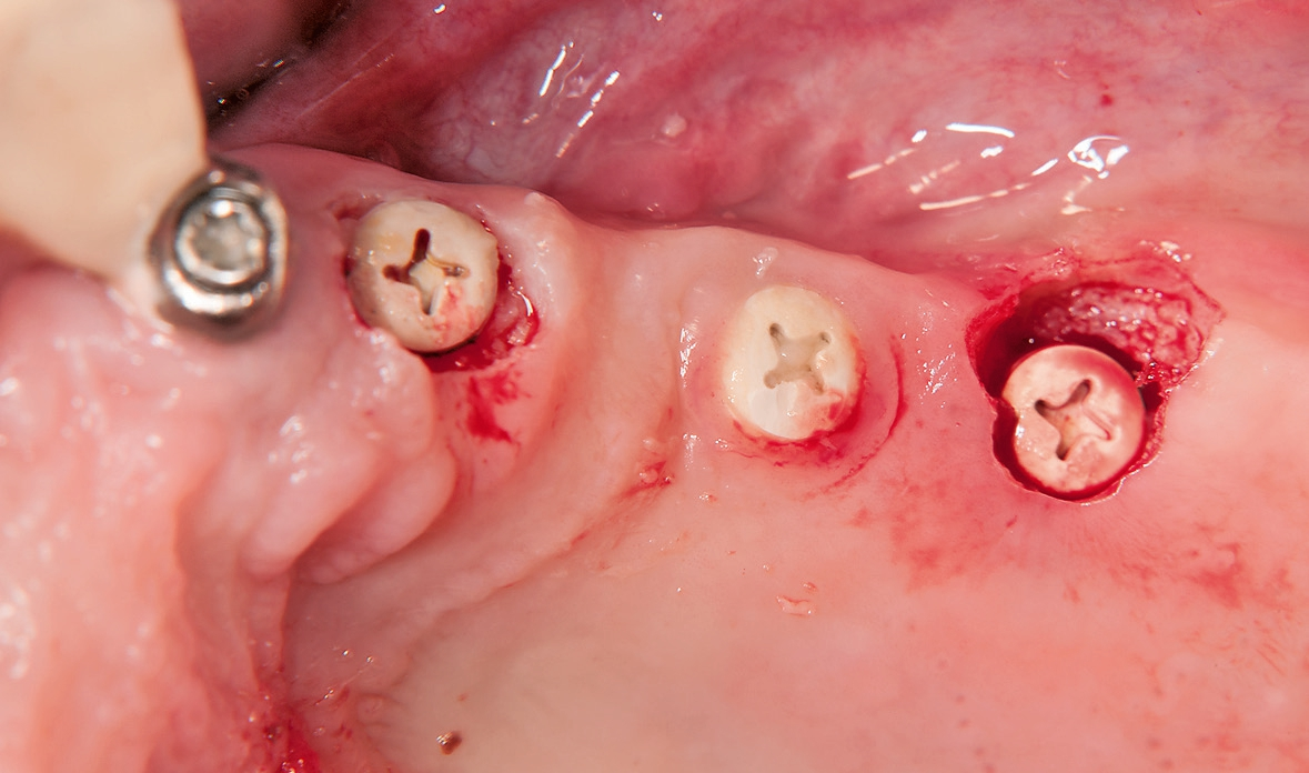 Abb. 13: Freilegen der Implantate bzw. Healingcaps.