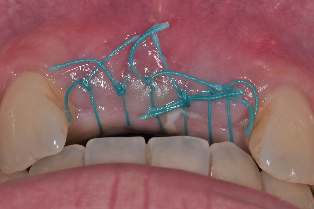 Abb. 14: Die klinische Situation drei Monate später zeigt die provisorische Krone zur Freilegung und die Möglichkeit eines individuellen Gingivaformers für die Weichgewebemodellierung.