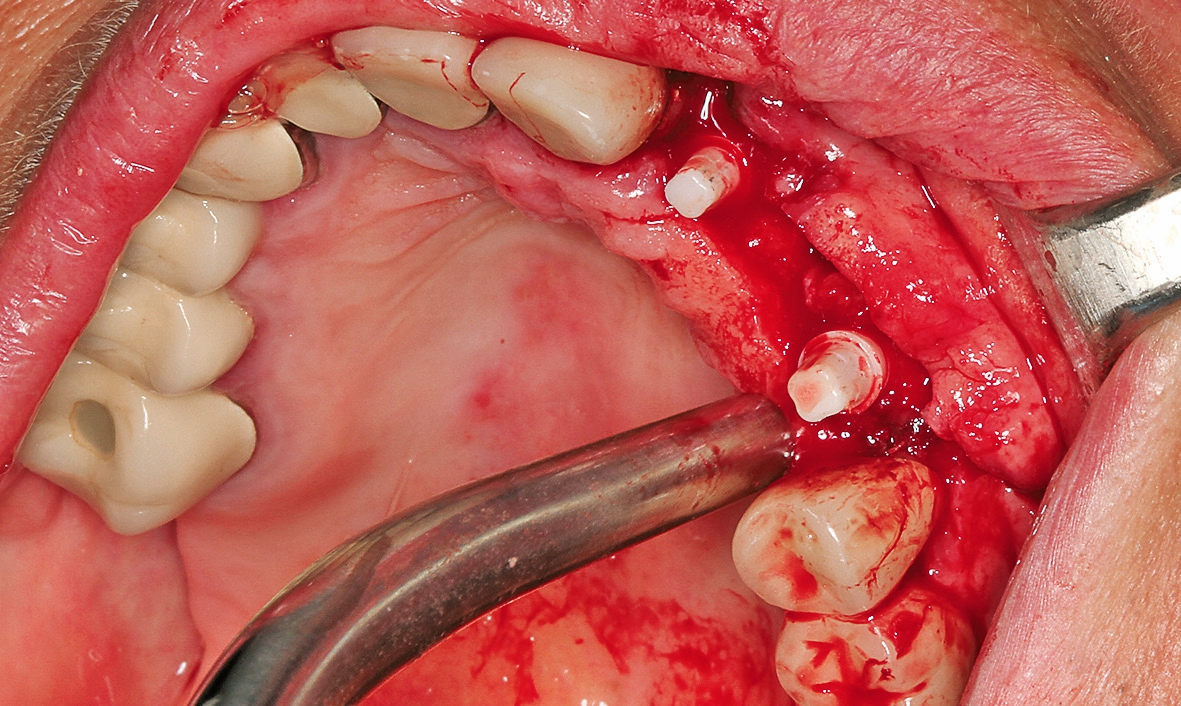 Abb. 13: Die finale Positionierung der Implantate nach Entnahme der Bohrschablone.