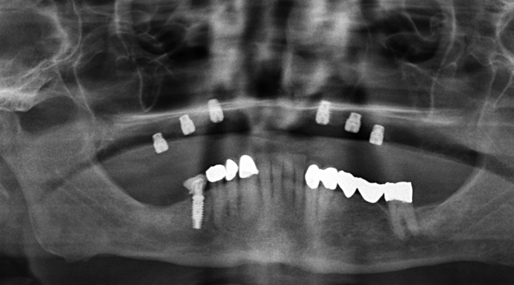 Abb. 18: Röntgenkontrolle nach Insertion von sechs kurzen Implantaten (SICmax).