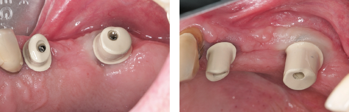 Abb. 15–16: Gemäß der „One-Time-Abutment“-Therapie eingebrachte BioHPP SKY elegance prefab Abutments in palatinaler und bukkaler Ansicht.