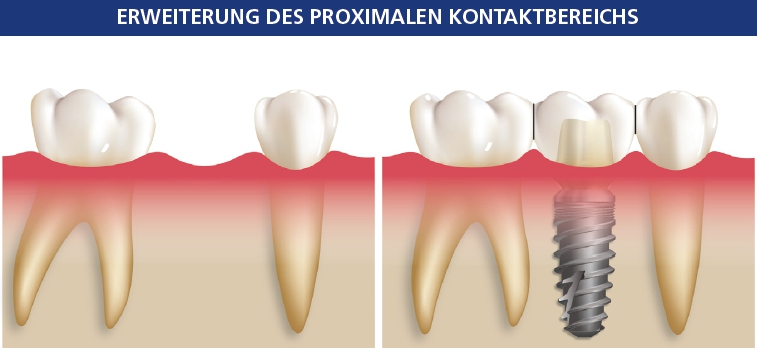 Abb. 8a und b: Ein langer, paralleler proximaler Kontaktbereich ermöglicht eine bessere Kraftverteilung zwischen Implantaten und den natürlichen Zähnen. Ein zusätzlicher Vorteil besteht in dem vereinfachten Prozess, bei dem es nur einen Insertionsweg für den Zahnersatz gibt. Der lange Kontaktbereich lässt sich mit einer Schmelzplastik vor der abschließenden Abformung erreichen, wodurch parallele interproximale Kontakte möglich werden.