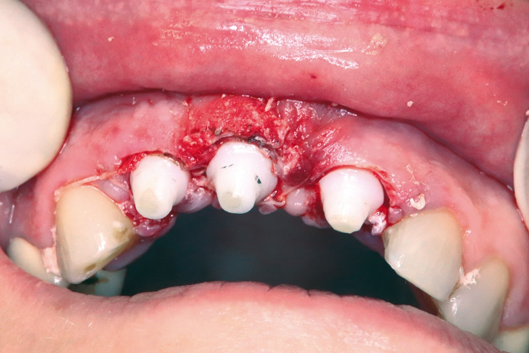 Abb. 14: Präparation der Implantate. Abb. 15: Provisorische Versorgung.