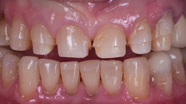Abb. 13: Reduzierte Präparation der Frontzähne für Teilkronen und Veneers, regio 13 bis 23; Unterkieferzähne mit Komposit aufgebaut.