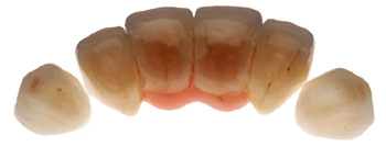Abb. 6a: 4-gliedrige implantatgetragene Frontzahnbrücke von 12 bis 22 mit Gerüst aus Zirkoniumoxidkeramik (IPS e.max ZirCAD LT) mit manuell geschichteter Verblendung (IPS e.max Ceram, Schichttechnik). Für die Eckzähne wurden Full-wrap(360°)-Veneers aus Lithiumdisilikatkeramik (IPS e.max Press LT, Ivoclar Vivadent) und einer manuellen Verblendung aus Nano-Fluorapatit-Glaskeramik (IPS e.max Ceram) angefertigt.