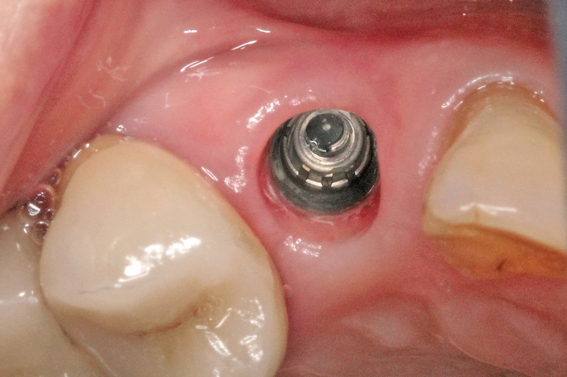 Abb. 13: Trichterförmige Emergenz nach Entnahme des Healing-Abutments.
