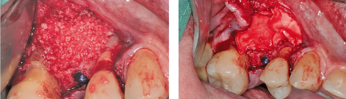Abb. 12a und b: Augmentation mit allogenem Material und Abdeckung mit Kollagenmembran zur Verdickung der Gingiva.