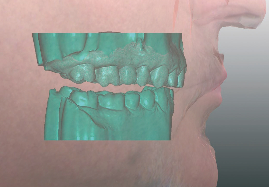 Abb. 9a: Überlagerung von Gesichtsscan und Intraoralscan.