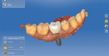 Abb. 13: Design des Provisoriums.