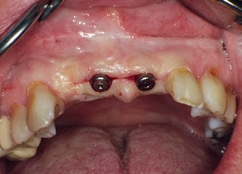 Abb. 13: Implantatfreilegung mit Einheilabutments/Gingivaformer für ein ästhetisches Emergenzprofil.
