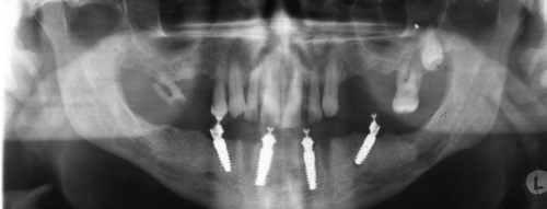 Abb. 13: OPG post-OP.