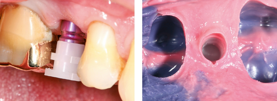 Abb. 14 und 15: Situation mit aufgesetzter Abformkappe und Implantatüberabformung.