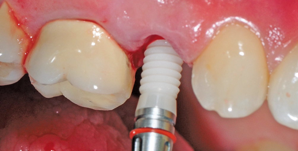 Abb. 13: Langsam wurde das yttriumstabilisierte Implantat in das Knochenbett inseriert.