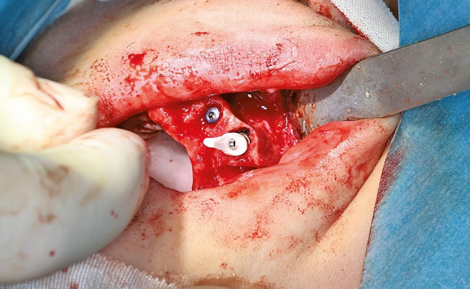 Abb. 13: Megagen Fuse Abutments in situ.
