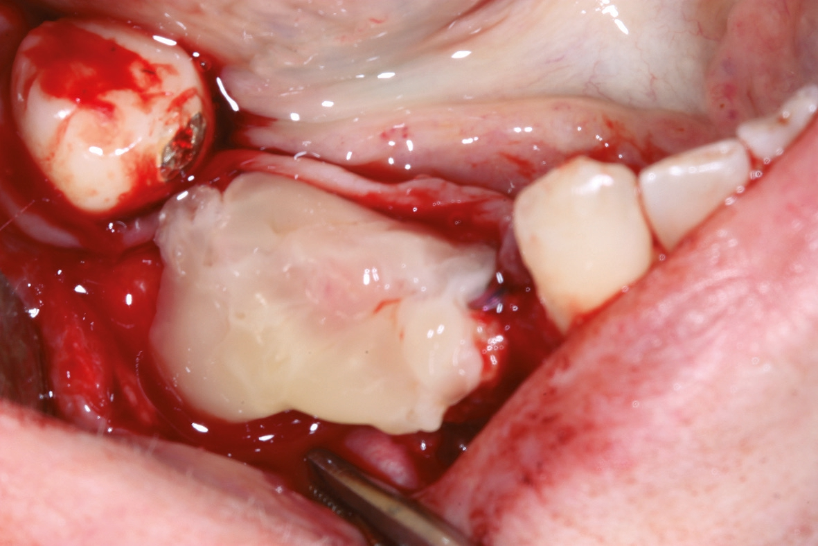 Abb. 13: Abdeckung der Implantate mit einer A-PRF-Fibrinmatrix.