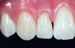 Abb. 13: Versorgung mit OMNICHROMA mit sehr guter Farbadaptation des Kantenaufbaus.