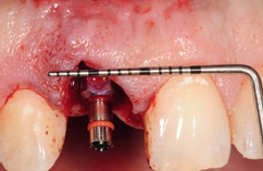 Abb. 12: Die Implantatschulter wurde in vertikaler Dimension 3 bis 4 mm unterhalb des Verlaufs des Gingivasaums am benachbarten Zahn 21 positioniert.