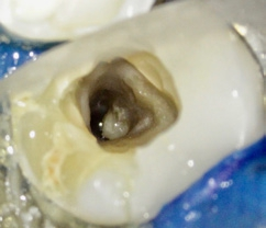 Abb. 13: Zahn 37 mit Dentikel im Bereich der Wurzelkanalöffnung.