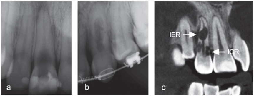Abb. 12a: Interne entzündliche Resorption an 11. b: Interne Ersatzresorption am Zahn 23. c: Eine interne entzündliche Resorption (IER) breitet sich vom Wurzelkanal aus und zerstört zunächst perikanaläres Dentin. Dagegen dringen invasive zervikale Resorptionen (ICR) am Zahnhals ein und das perikanaläre Dentin (PRRS) bleibt bis zuletzt bestehen.