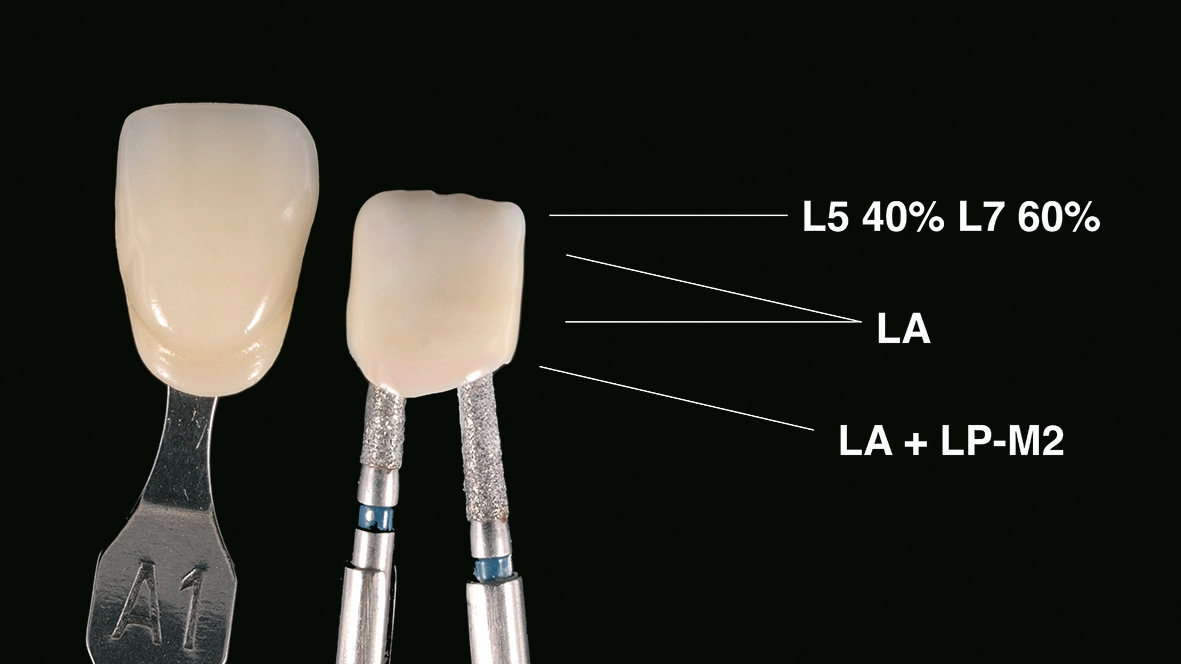 Abb. 13: Lasur mit LA, inzisal wird mit „violet“ mehr Tiefenwirkung erzeugt, zervikal wird der Rotwert durch Zugabe von LP-M2 (Gum) erhöht.