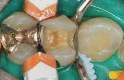 Abb. 13: Die versiegelte Dentinfläche nach der 3s-PowerCure-Polymerisation des Adhäsivs.