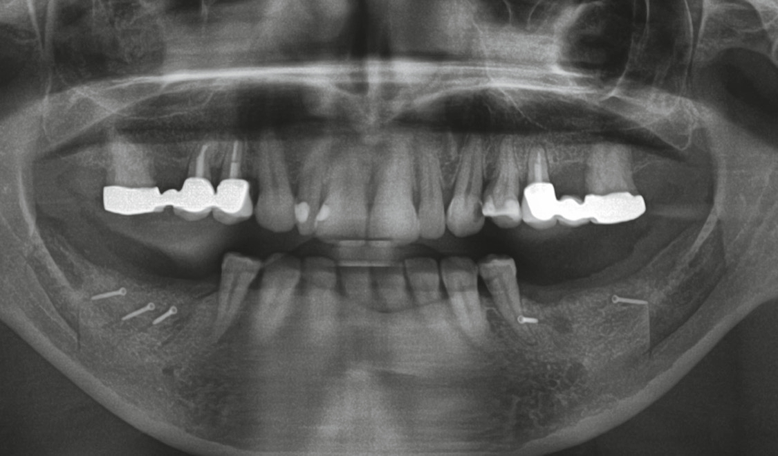 Abb. 14: Das postoperative Röntgenbild zeigt deutlich die Knochenentnahmestelle im 4. Quadranten und den augmentierten Bereich.