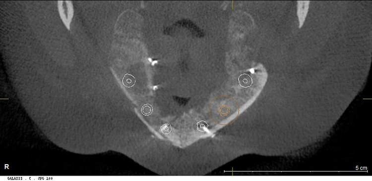 Abb. 13: DVT nach Augmentation.