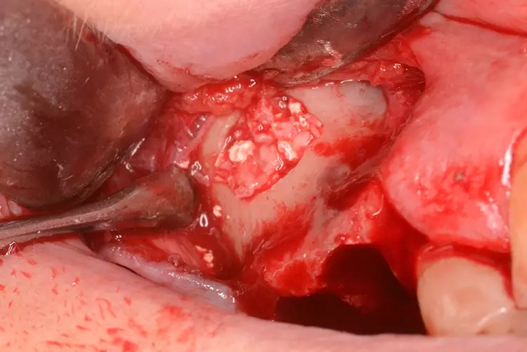 Abb. 13: Augmentation 16.
