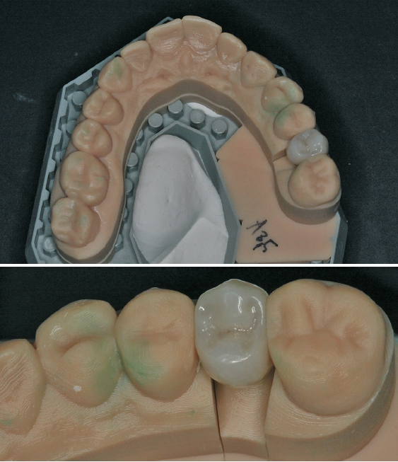Abb. 12a u. b: Die Zirkoniumdioxid-Krone auf dem gedruckten Dentalmodell.