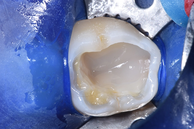 Abb. 14: Schrittweise Schichtung mit Tetric Prime.